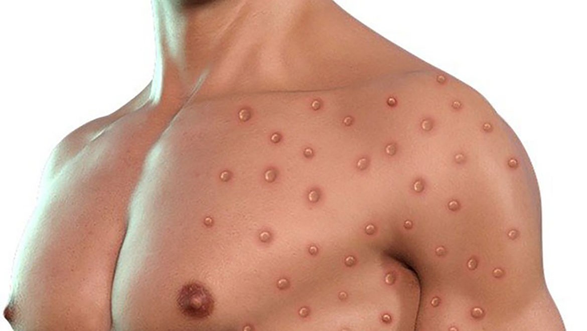 Nijerya'da M çiçeği vaka sayısı 48'e yükseldi