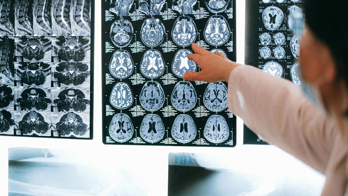 Alzheimeri orta yaşta saptayan kan testi geliştirildi